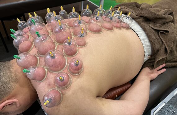 腰の痛みでお困りでカッピング療法をご希望の40代女性がPRIMO鍼灸整骨院に来院されました！